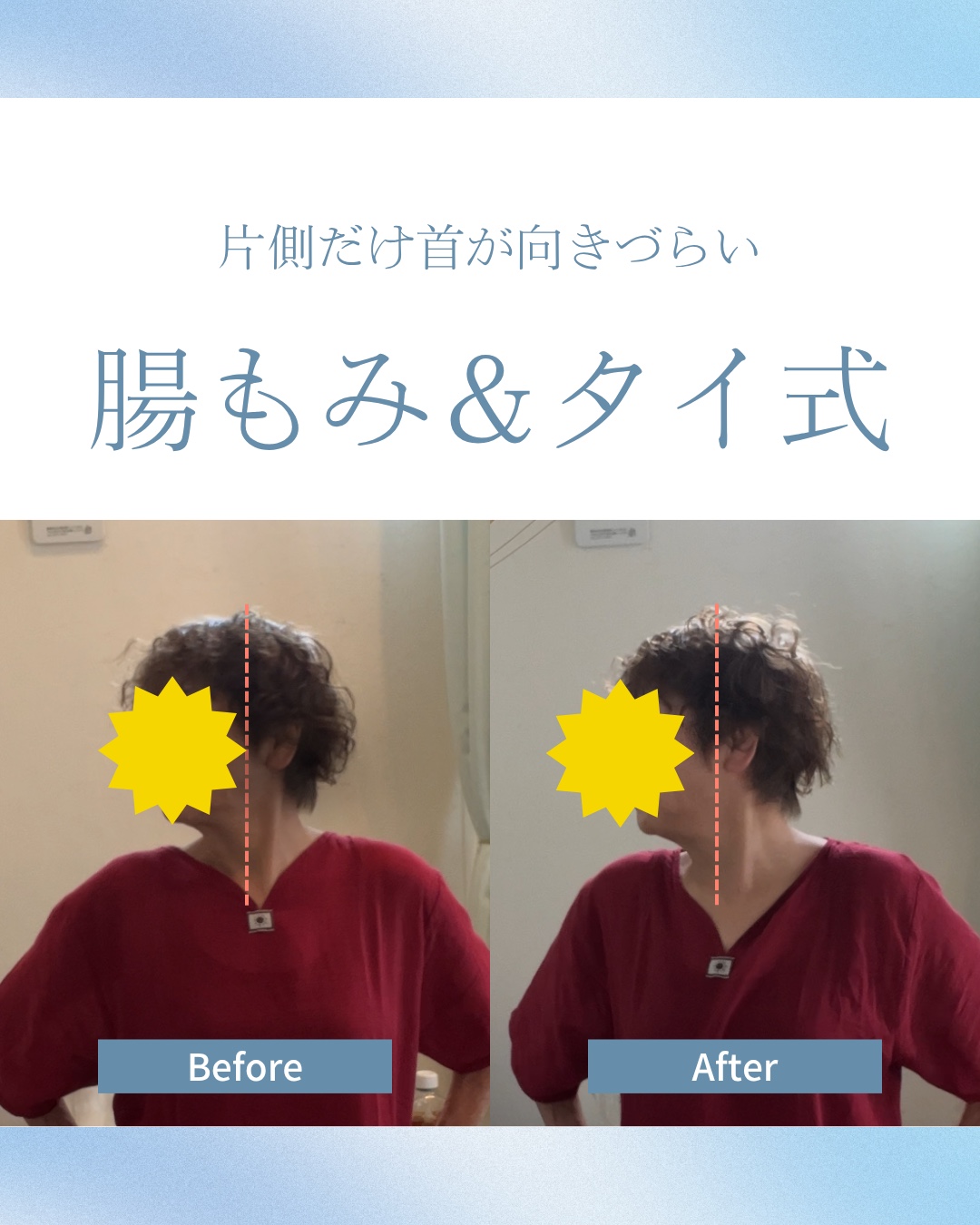 60代女性が首を横へ向けた状態を施術前後で比較した写真