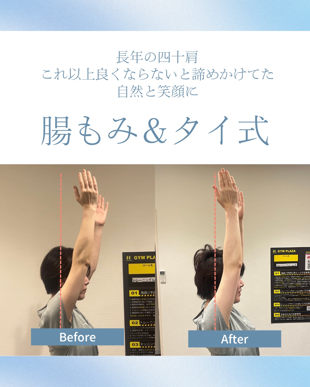50代女性が腕を上げた状態を施術前後で比較した写真