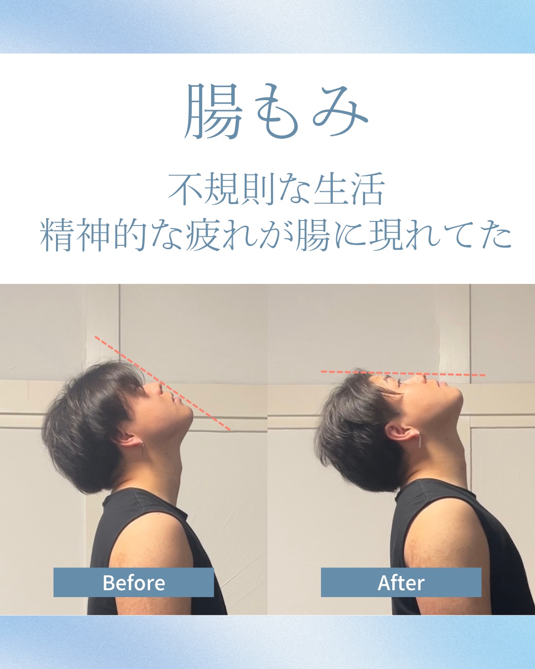 20代男性が上を向いた状態を施術前後で比較した写真